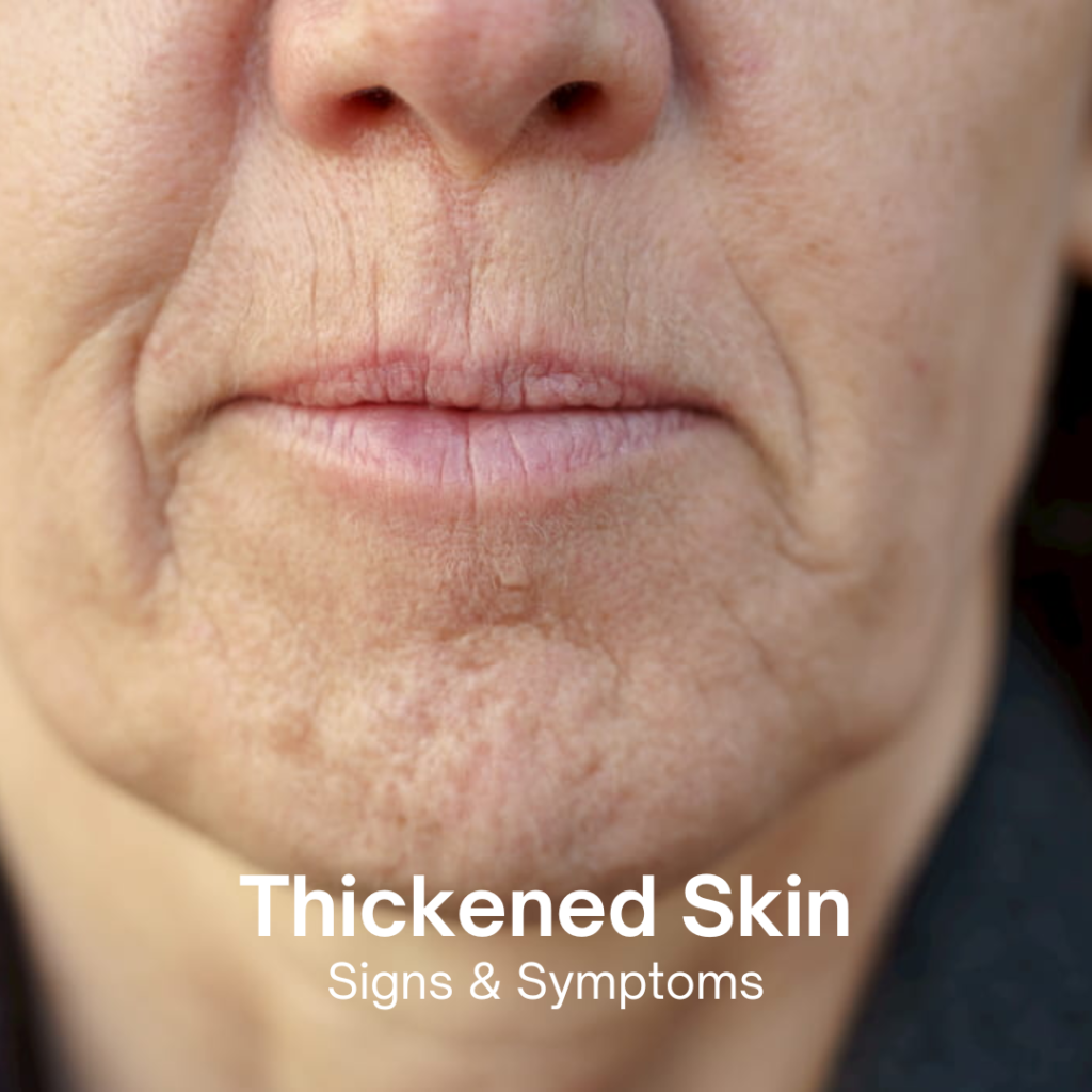 thickened skin