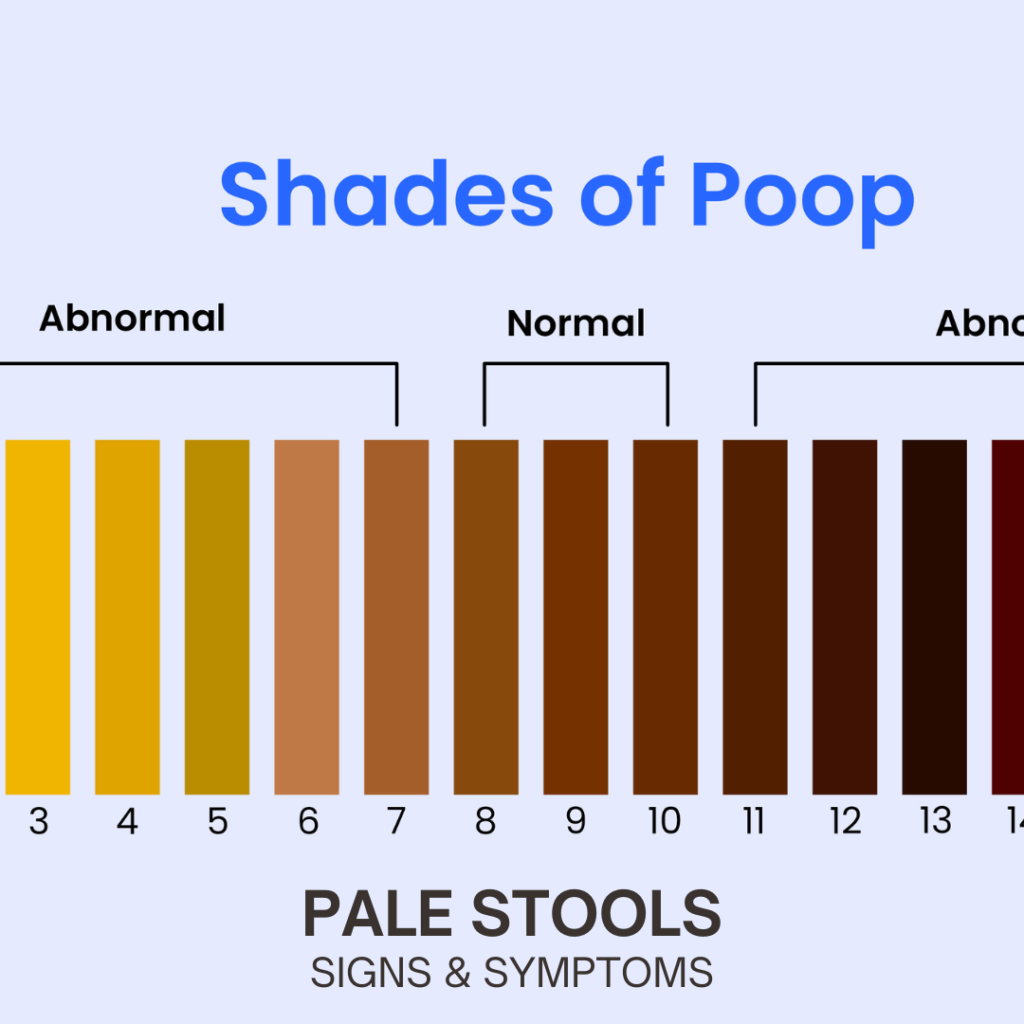 Understanding Pale Stools: Causes, Diagnosis, and Treatment