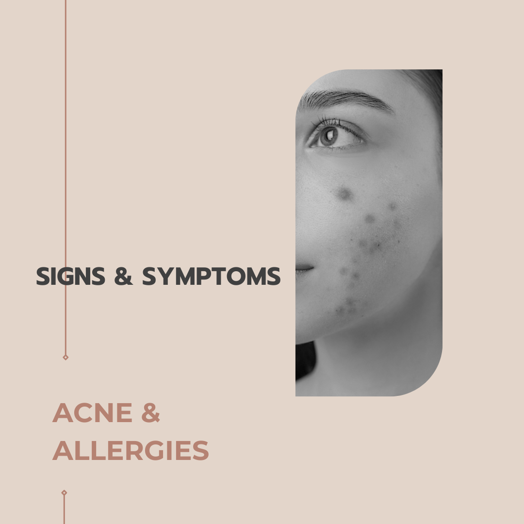 Acne and Allergies