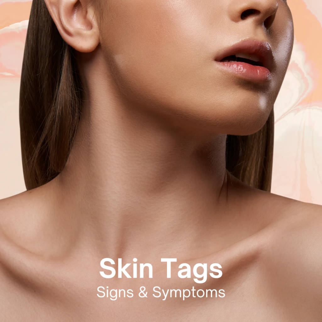 skin tags