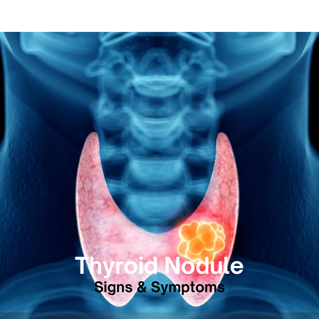 thyroid nodute