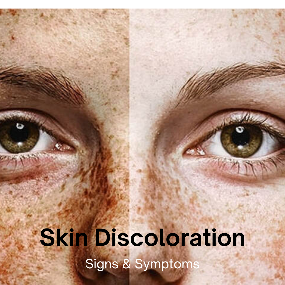 skin discotoration