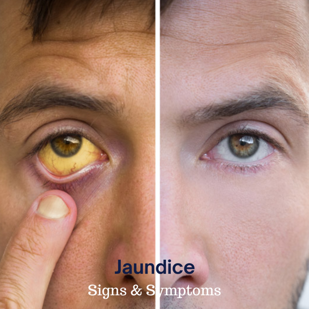 jaundice